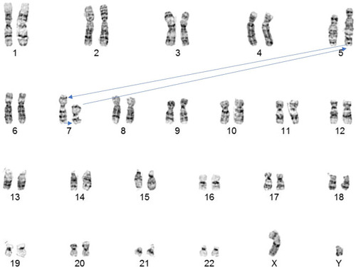 Figure 1 Karyotype. 46,XY,t(5;7;7) (q33.2; q32; q11.2). Arrows indicate the direction of the transfer of chromosomal material between the derivative chromosomes 5, 7 and 7.