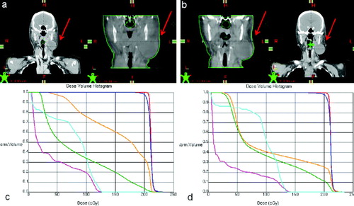 Figure 4.  Patient geometry at simulation (a, left) with corresponding image-guidance CT prior to treatment fraction 1 (a, right), and at re-simulation (b, right) with corresponding CBCT at treatment fraction 23 (b, left). Comparative DVHs are presented below corresponding CT data sets with PTV in blue, GTV in red, spinal cord in teal, brainstem in pink, right parotid in green, and left parotid in orange.