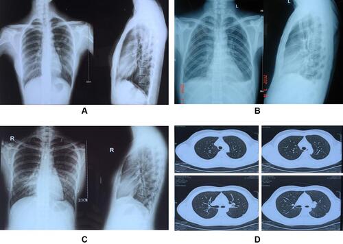 Figure 1 Chest X-ray examination. (A) Pleural adhesion with pulmonary lesions. (B) Pleural adhesion with a blunt costophrenic angle. (C) Localized pleural adhesion only. (D) CT scan shows a localized pleural adhesion.