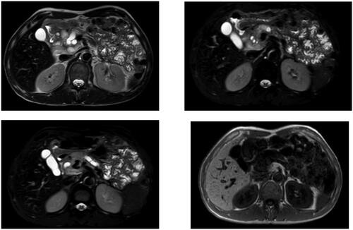 Figure 2. Pancreatic duct dilation, multiple stones and chronic pancreatitis with the possibility of formation of pancreatic head pseudocysts.