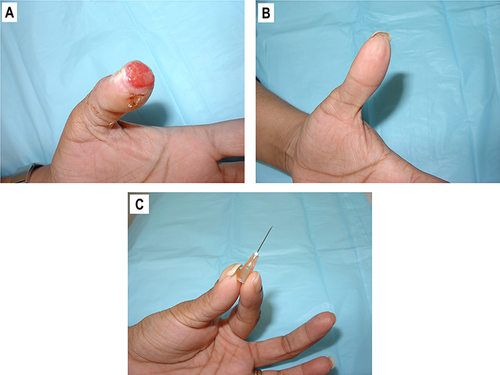 Figure 6 (A) Open wound at the tip of the left thumb, 2 x 2cm. (B) Wound healed by secondary intention upon semi-occlusive dressings treatment. (C) Restoration of pinch function.