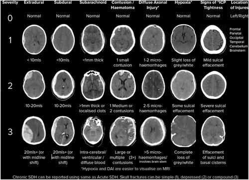 Figure 1. The SBNS TBI CT Classification. All brain injuries are scored between zero and three. Additionally, a score can be assigned to ‘mild TBI/concussion’ with a history of TBI but no evidence on CT. There is also a score for ‘tightness’ representing the resulting raised ICP (sulcal, ventricular and basal cistern effacement). Hence, possible scores are: mild TBI (m + ve/−ve), extradural (E 0–3), subdural (SD 0–3), subarachnoid (SA 0–3), contusion (C 0–3), diffuse axonal injury (DA 0–3), hypoxia (H 0–3), + ‘Tightness’ (0–3).
