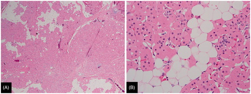 Figure 4. (A). Histologic section of oncocytic lipoadenoma showing solid islands of pink oncocytic cells admixed with mature adipose tissue (H&E, 40×). (B). High power view showing the oncocytic cells which exhibit abundant fine granular eosinophilic cytoplasm and a single small round nucleus. Oncocytes are admixed with mature fat (H&E, 400×).