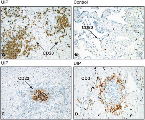 Figure 2. Photomicrographs of lung biopsies from a patient with IPF (A), and control lung (B) stained with the antibodies against the B-lymphocyte marker CD20. Photomicrographs of lymphoid aggregates in IPF lung stained with antibodies against CD23 (activated B cells, dendritic cells and EBV-transformed lymphoblasts) (C), and CD3 (T cells) (D). Original magnification 300×.