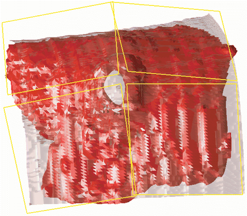Figure 16. The 5-W/kg SAR isosurface resulting from scaling factors [4.25, 3, 3.5, 4.25]. The hole in the isosurface at the tumour centre is clearly visible.