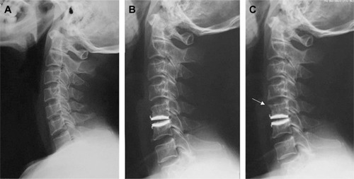 Figure 3 Radiographs of a 46-year-old man with a high T1 slope. (A) Preoperative; (B) immediate postoperative; and (C) final follow-up. New osteophyte formation can be seen at the superior level (C4-5; arrow).