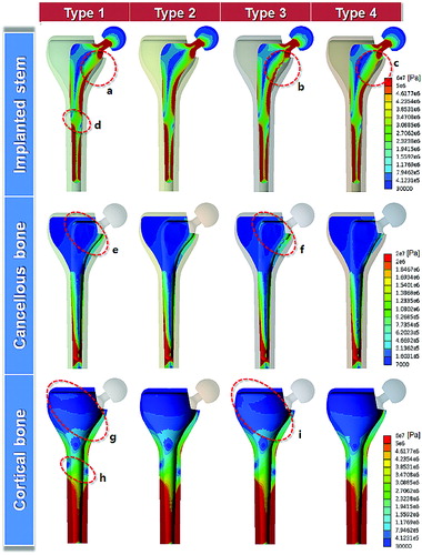 Figure 5. Equivalent stress distribution at the cross-section along the length of the implanted stem, cancellous bone and cortical bone.