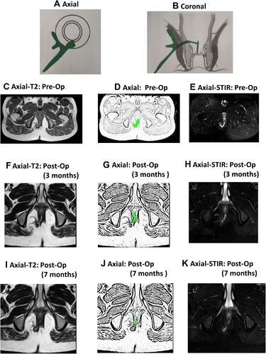 Figure 6 A 37-year-old male patient with a recurrent high transsphincteric fistula. MRI done 3 months after surgery showed incomplete healing with a weighted score of 9 as per the new scoring system (NSS). MRI done 7 months after surgery showed incomplete healing with a weighted score of 8. The healing was slow but progressive as can be made out from sequential MRIs at 3 and 7 months. Therefore, the patient was kept under observation and the fistula healed completely 9 months after surgery. The patient is asymptomatic after a follow-up of 39 months. (A) Axial section (schematic diagram); (B) coronal section (schematic diagram); (C) pre-operative axial T2-weighted MRI; (D) sketch of figure-(C) (fistula shown in green color); (E) pre-operative axial STIR MRI; (F) post-operative axial T2-weighted MRI showing fistula not healed at 3 months; (G) sketch of figure-(F) (fistula shown in green color); (H) post-operative axial STIR MRI showing fistula not healed at 3 months after surgery; (I) post-operative axial T2-weighted MRI showing fistula much smaller but still not healed 7 months after surgery; (J) sketch of figure-(I); (K) post-operative axial STIR MRI showing fistula not healed 7 months after surgery.