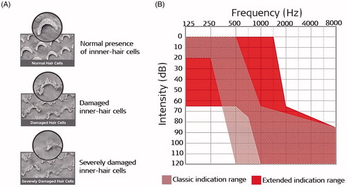 Figure 1. Morphology of inner-hair cells in three different conditions (A) [Citation2]. Typical audiogram of a partially deaf patient with severe to profound HL in the HF region: indication from the earlier times when the functional LF residual hearing cut-off was kept at 500 Hz which was extended to 1,500Hz under expanded indication criteria (indication 2) (B). Image (A) reproduced by permission of www.davidsonhearingaids.com.