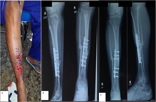 Figure 5 Sample case of infection from study with open fracture tibia-fibula directly performed ORIF in acute onset disaster, (A) Current clinical picture, (B) one-month post-operative X-ray, (C) one-year post-operative X-ray.