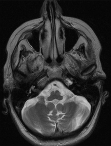 Figure 1 Axial, T2-weighted magnetic resonance image of the patient, showing atrophy of the cerebellum and the cerebellar vermis.