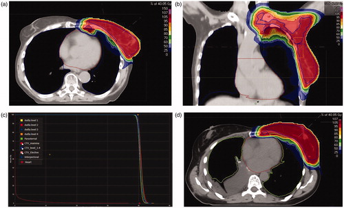 Figure 1. (a) Dose distribution for patient 4; (b) Dose distribution for patient 4; (c) Dose volume histogram for the planning CT of patient 4. (d) Dose distribution for patient 7.