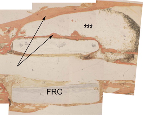 Figure 5. Histological image at 20 weeks, with van Giesson stain (reconstructed from 5 pictures). Longitudinally sectioned sample showing double cortex (arrows), with marrow (***), fiber reinforcement (FRC), and intramedullary canal.