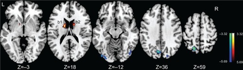 Figure 1 Brain regions with increased/decreased amplitude of low-frequency fluctuation (ALFF) in pediatric bipolar disorder patients are superimposed on a T1 template.