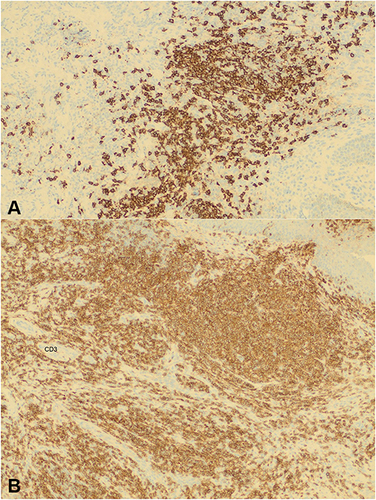 Figure 3 (A) (200×) Immunohistochemical stains show strong positivity of the large cells with CD20. (B) (200×) The reactive small lymphocytic populations are positive for CD3 immunohistochemical stain.