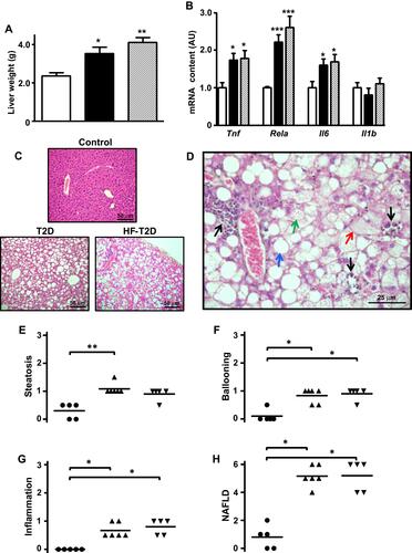 Figure 2 Type 2 diabetes (T2D) induces severe NAFLD. Liver from control (C, white bars, circles), type 2 diabetic (T2D, black bars, up triangles) and high-fat-fed T2D (HF-T2D, dashed bars, down triangles) mice were analyzed. (A), liver weight; (B) mRNA expression of inflammatory markers Tnf, Rela, Il6 and Il1b; (C) hematoxylin-eosin stained liver tissue revealing evident steatosis in T2 mice (20X magnification); (D) increased magnification (40X) of hematoxylin-eosin stained liver tissue from T2D mice revealing the presence of micro-steatosis (green arrow), macro-steatosis (red arrow), ballooning (blue arrow) and inflammatory foci (black arrows); (E-G) steatosis, ballooning and inflammation grade; (H) NAFLD score. Data are expressed as mean ± SEM of 10 to 16 (A) or 6 to 8 animals (B). In (E–H), data are the means and the individual values of 5 animals. The means were analyzed by one-way ANOVA followed by the Newman-Keuls post-test (A, B) or Kruskal–Wallis followed by the Dun post-test (E–H). *P<0.05, **P<0.01 and ***P<0.001 vs (C).