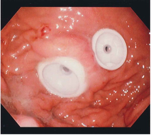 Figure 3. Endoscopic view of double-PEG, placed to improve the apposition and patching of the gastric and abdominal walls.