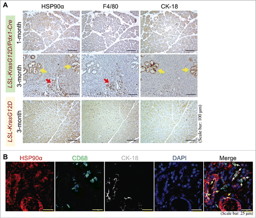 Figure 5. Pancreatic macrophages and ductal epithelial cells are two HSP90α-expressing cells during PDAC development. (A) Sequential pancreatic tissue sections from 1- or 3-month-old LSL-KrasG12D/Pdx1-Cre mice or 3-month-old LSL-KrasG12D mice were immunohistochemically stained with the antibodies against HSP90α, F4/80, and CK-18, respectively. The example images revealed that HSP90α+ cells were detected abundantly from the pancreatic tissues of LSL-KrasG12D/Pdx1-Cre mice at 3 months of age but not from the pancreatic tissues of 1-month-old LSL-KrasG12D/Pdx1-Cre mice and 3-month-old LSL-KrasG12D mice. These HSP90α-expressing cells included not only F4/80+ cells (macrophages, red arrow) but also CK-18+ cells (ductal epithelial cells, yellow arrows). (B) Example images of immunohistofluorescent staining of patients' PDAC specimens with HSP90α, CD68, and CK-18 antibodies, showing that HSP90α was expressed not only in macrophages (CD68+ cells, white arrows) but also in ductal epithelial cells (yellow arrows).