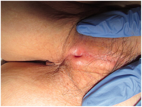 Figure 1. Both labia majora are extensively fused. There are two pinholes, but we could not identify the clitoris, vestibule, labia minora, and external urethral meatus.