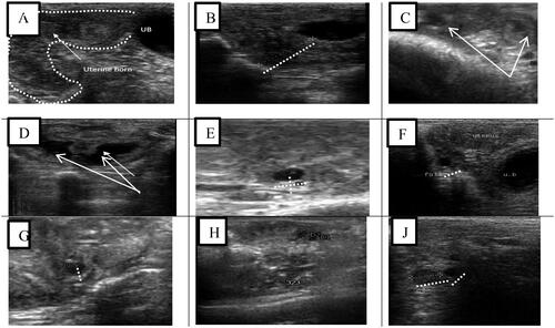 Figure 1. Ultrasonograms of genital tracts of non-pregnant ewes; (A–D) Sagittal section in the uterine horn, and uterine with clear hypoechogenicity, and scanty amount of fluid. (E–H) Follicular phase, large sized follicle (≤4mm), and small sized follicles (≤2mm). (J) Luteal phase, Corpus luteum, (≤0.5 mm).