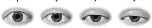 Figure 1 Eyelid position by degree of ptosis: (A) no ptosis, (B) mild ptosis, (C) moderate ptosis, (D) severe ptosis.
