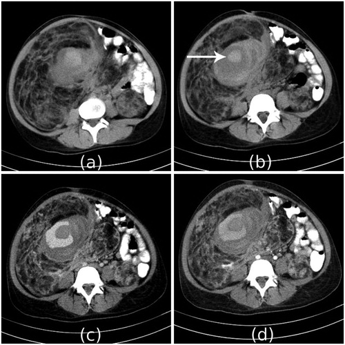 Figure 1. Non-contrast CT scan images (a), (b) show large mass of predominantly fat density replacing the right kidney. Similar lesion is also noted in the left kidney. It shows internal soft tissue and hyperdense area which represents acute hematoma (arrow). Arterial phase (c) and venous phase (d) images show contrast pooling in the lesion, which may suggest vascular ectasia.