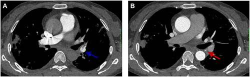 Figure 1 (A) The blue arrow shows the left bronchial artery–the left pulmonary artery fistula; filling defects can be seen in image. (B) The red arrow shows the thickened bronchial artery (over 2mm). (A and B) Irregular patchy and nodular density was observed in both lungs.