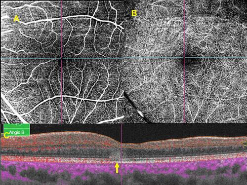 Figure 4 Acute macular neuroretinopathy (AMN) after COVID-19 vaccinations. (A and B) En face optical coherence tomography angiography images of the superficial capillary plexus (A) and deep capillary plexus (B) of the left eye of case 6. (C) A horizontal optical coherence tomography image with angiographic flow (shown in red) of the left eye of case 6 shows possible flow deficits in the deep capillary plexus and hyperreflective lesions affecting the outer plexiform and outer nuclear layers with disruption of the ellipsoid zone (arrow) consistent with AMN.
