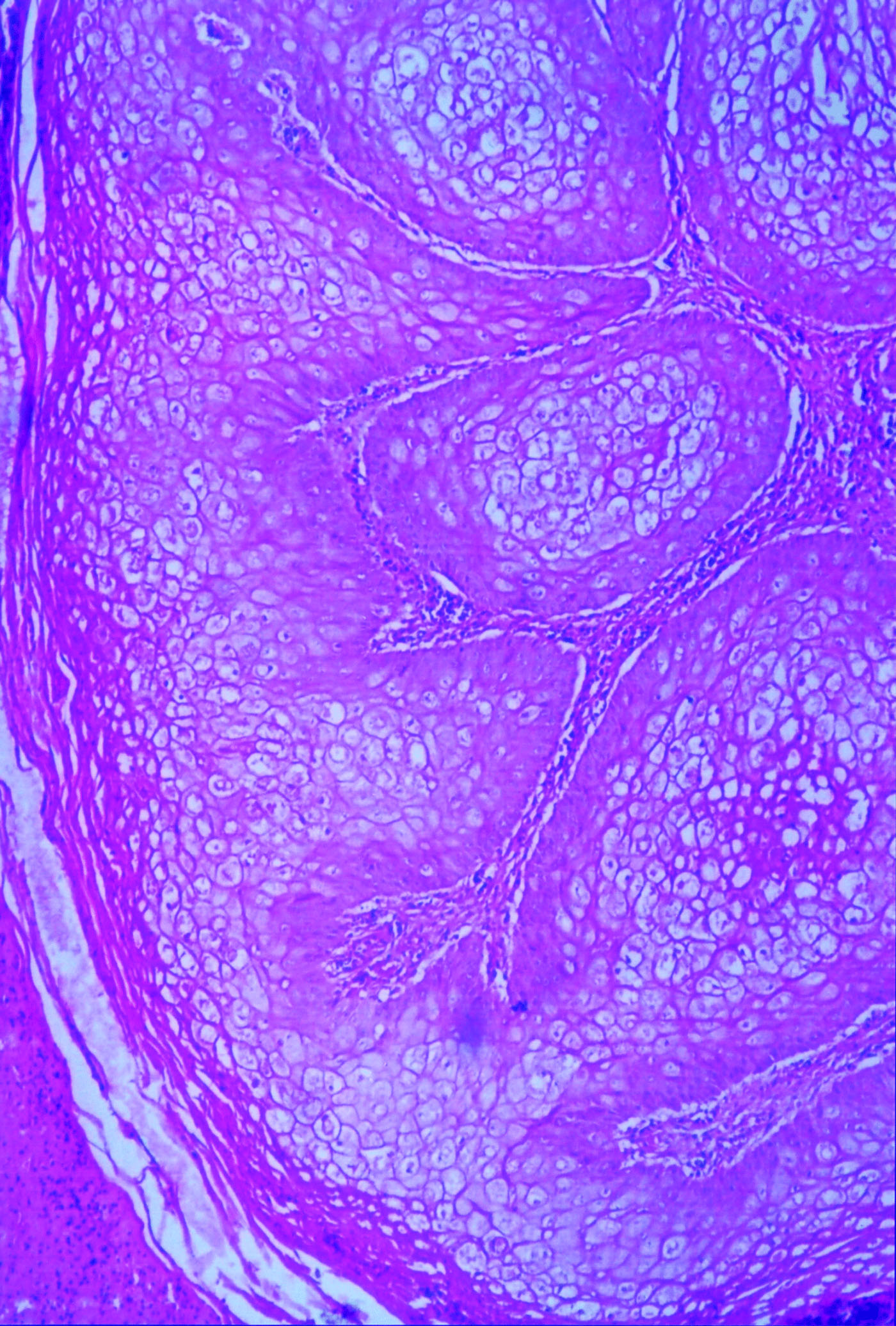 Figure 4.  Intact keratinized surface, excessive proliferation of fibrous connective tissue, lobular pattern and infiltration of heterophils and macrophages in peafowl chick suffering from avian pox. Haematoxylin and eosin. Magnification x40.