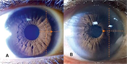 Figure 5 Clinical determination of shallow AC on anterior perspective (flashlight method). The horizontal line denotes the total width of the nasal iris traced from the nasal pupillary edge to the nasal limbus. The vertical line demarcates a temporal third of the total width. The dot on the horizontal line marks the start of the iris shadow. (A) Normal ACD on anterior perspective. The start of the iris shadow is on the nasal side of the vertical line depicting >two-thirds of nasal iris being illuminated. (B) Shallow ACD on anterior perspective. The start of the iris shadow is on the temporal side of the vertical line depicting less than a third of the nasal iris being illuminated.