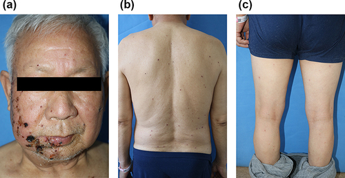 Figure 1 A case of disseminated herpes zoster with HIV infection in an elderly man. (a–c) are the conditions of the patient’s head/face, back, and limbs at admission, respectively.