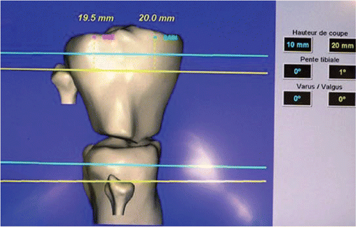 Figure 5. Screenshot showing the difference in height between the ideal cut (with reference to the level of the joint line) (blue line) and the actual bone cut through the remaining bone (yellow line). In this example, the bone defect was measured at 10 mm. [Color version available online.]