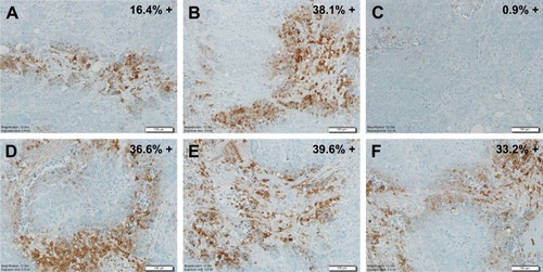 Figure 3 Hypoxyprobe™-1IHC staining in human ovarian tissue sections. The A–C, and D–E, respectively represent three separate tissue sections from two ovarian tumors; Percent positive staining for Hypoxyprobe™-1 is indicated. All pictures are 20× magnification.Note: IHC staining performed by the Tissue Acquisition and Cellular/Molecular Analysis Shared Resource (TACMASS); the core at the University of Arizona Cancer Center and analysis done by Dr Amanda Baker.Abbreviation: IHC, immunohistochemistry.