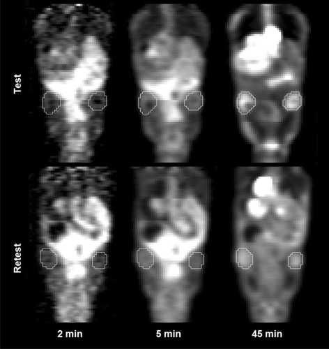 Figure 1. Coronal test (upper) and retest (lower) dynamic FDG-PET images for an individual representative animal implanted with MAS98.12 breast cancer xenografts at acquisition times 2 min, 5 min and 45 min. Tumours segmented in final frame images of test and retest scans are shown throughout.