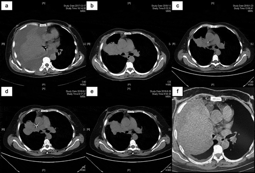 Figure 1. Computed tomography scan at time of admission (a). Over two cycles of R-CHOP and six cycles of R2-CHOP treatment, the patient demonstrated disappearance of pleural effusion and gradual shrinkage of the tumor mass, followed by subsequent recurrence and refractory disease (b–d). Subsequent chemotherapy regimens did not benefit the patient and there were no substantial changes in the lung masses (e). Within two months of using ibrutinib, the patient developed rapid DR and disease progression, and the lung mass increased progressively (f).