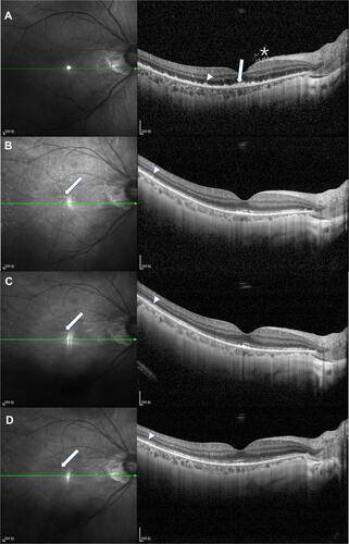 Figure 2 OCT images of eye 6. (A) Before intravitreal methotrexate, OCT revealed outer retina fuzzy borders (arrow),preretinal deposits (asterisk) and focal subretinal deposits (arrow head). (B) After induction phase, the above abnormalities disappeared. On near-infrared image, numerous scattered hyperreflective dots with clear border were observed (arrow). Horizontal scan showed that these dots were between the retinal pigment epithelium and the ellipsoid zone. (arrow head) (C) After consolidation phase, subretinal dots remained stable both on near-infrared and horizontal scan image. (D) After maintenance phase, subretinal dots still remained stable.