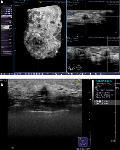 Figure 7 Case from the database demonstrating a BI-RADS®-US 5 lesion that remained occult in the mammogram. The lesion was easily detected in the volume data set by examiner 2 (A) and a second-look ultrasound (B) with histological confirmation was correctly requested.