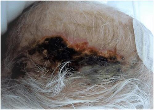 Figure 1 Skin necrosis over the temporoparietal scalp area in a patient with giant cell arteritis.