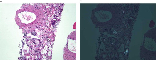 Figure 1. Kidney biopsy from a 43-year-old woman with acute chronic renal failure. The specimen is examined using an H&E stain at a magnification of 100 × the original size. In Figure 1a, the specimen is examined under bright-field microscopy, showing an acute tubulointerstitial process superimposed on chronic parenchymal damage. There is diffuse acute tubular injury with interstitial edema as well as substantial background fibrosis (40–50%). An active inflammatory infiltrate is seen; however, there are no granulomas and eosinophils are not prominent. In Figure 1b, the specimen is examined under plane-polarized illumination. White birefringence from calcium oxalate type crystals are present within nonscarred areas, suggesting recent deposition. The history of recent ethylene glycol ingestion is the likely etiology.