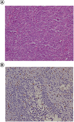 Figure 1. Histopathological images of the tumor with micropscopy and immunohistochemistry.(A) Representative histophotomicrograph of the tumor showing cells with prominent nucleoli and moderate to abundant cytoplasm arranged in sheets showing epithelioid morphology. (B) Immunohistochemical stain for INI1 protein showing loss of its expression compared with positive internal control.