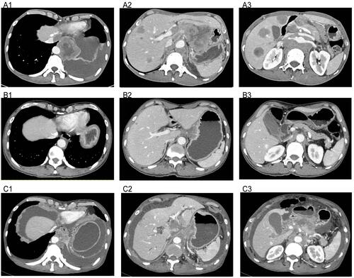 Figure 4 Computed tomography images of the treatment with apatinib plus irinotecan. (A1–A3) Before the treatment of apatinib and irinotecan on September 30, 2017. (B1–B3) Efficacy of apatinib and irinotecan treatment on May 14, 2018. (C1–C3) Disease progressed after apatinib plus irinotecan treatment on October 15, 2018.