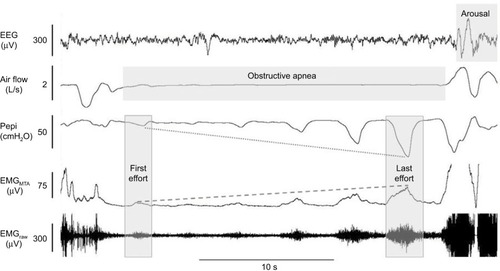 Figure 4 Example of robust genioglossus muscle responsiveness without restoration of airflow.