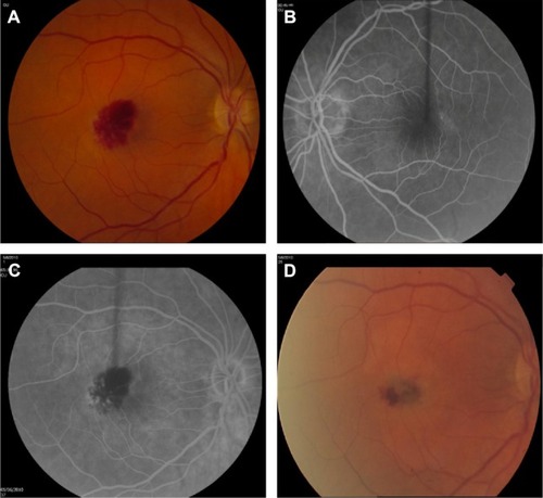 Figure 1 Fundus photographs and arteriovenous phase of fluorescein angiogram in case 1.