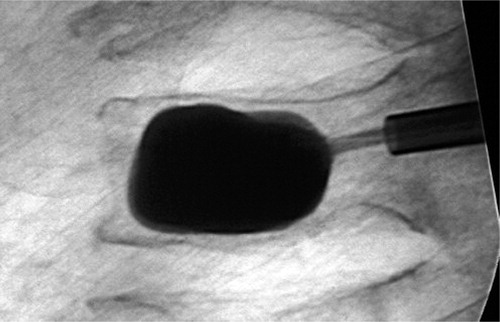 Figure 2. A kyphoplasty performed in the third lumbar vertebra of a 69-year-old man with an osteoporotic fracture.