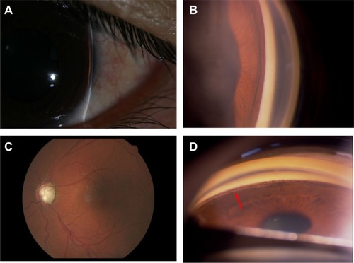 Figure 2 (A) Peripheral anterior chamber angle width assessment using the Von Herrick method on biomicroscopy in the left eye of patient 3. (B) Dynamic gonioscopy shows that the nasal angle is closed due to massive peripheral anterior synechiae. (C) The cup of the optic nerve head in the left eye is enlarged to the edge of the disc (vertical cup/disc ratio of 1.0). (D) The trabecular meshwork is exposed after the procedure (arrow), with remnant pigment granules on the Schwalbe’s line and trabecular meshwork.