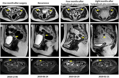 Figure 2 Magnetic resonance imaging results of pelvic cavity, pelvic floor peritoneum and abdominal wall one month after surgery (A–C), at recurrence (D–F), four months (G–I) and eight months (J–L) after everolimus plus Toripalimab. The yellow arrow represents the lesion.