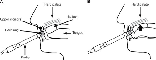 Figure 1 Tongue–palate pressure test.