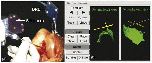 Figure 4. (A) Digitizing the notch surface points with the computer-tracked Stille hook. The femur is tracked through the dynamic reference base (DRB). (B) The digitized notch surface is visualized in three dimensions with a Levenberg-Marquardt algorithm for better orientation. The CAS system is calculating the cylinder-algorithm to fit the notch surface. Left: notch view; right: lateral-medial view.
