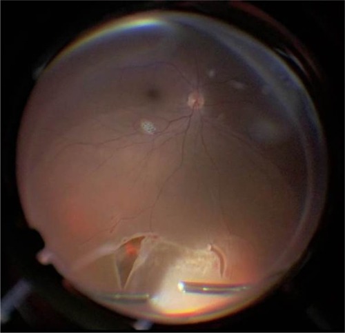 Figure 2 Fundus view of the contact lens with the noncontact wide-angle viewing system in a case of rhegmatogenous retinal detachment.