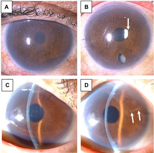 Figure 1 Representative cases with surgery-induced iris abnormalities after DMEK. (A) Case 1: a 69-year-old man had bullous keratopathy after cytomegalovirus corneal endotheliitis in his right eye. This eye was pseudophakic. (B) Case 1, after solitary DMEK, mild ovalization of the pupil (arrow), likely due to posterior synechiae, was noted. (C) Case 2: a 73-year-old woman had laser iridotomy-related bullous keratopathy in her right eye. This eye was pseudophakic. (D) Case 2, after solitary DMEK, mild iris depigmentation (arrows) was detected near the temporal wound.
